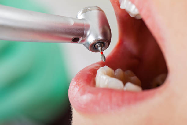 Best Emergency Wisdom Teeth Removal in Goodwell, OK